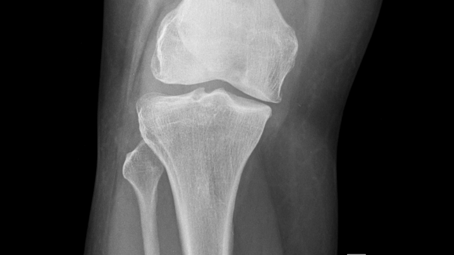 Injuries Commonly Caused by a West Phoenix Wrong-Way Crash